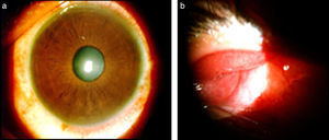 a) Fotografía clínica de segmento anterior de ojo derecho con técnica de iluminación difusa, donde se observa inyección ciliar mixta. b) Fotografía clínica de conjuntiva tarsal donde se aprecia quemosis 3+.