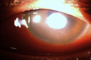 Aspecto inicial de la úlcera corneal de 1.8×2mm, de bordes difusos.