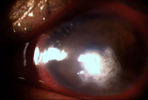 Presencia de cianoacrilato bloqueando la microperforación y zonas de mayor adelgazamiento de estroma corneal, abarcando los bordes temporal, inferior y nasal de la úlcera con reformación de la cámara anterior.