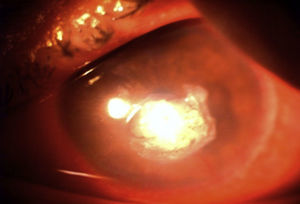 Mejoría en el aspecto de la úlcera corneal en presencia aún de cianoacrilato.