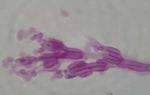 Morfología del hongo recuperado de la lesión de córnea, Paecilomyces lilacinus, con tinción de PAS ×1,000 en la que se observan fiálides agrupadas en forma de racimo de las que nacen conidios redondos.