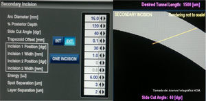 Incisión corneal secundaria: pantalla de programación para la incisión corneal secundaria en un plano con una longitud de 1,500μm.