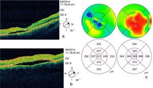 OCT inicial. OCT de dominio temporal que muestra hiporreflectividad subfoveal, con foveosquisis y desprendimiento del EPR en ambos ojos secundarios a la presencia de líquido subretiniano (a y b), principalmente en ojo izquierdo (b), con edema macular en Ol como se muestra en el mapa de grosor macular.