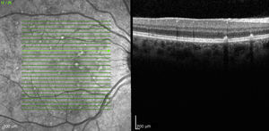 Tomografía óptica de coherencia OD: acúmulos hiperreflectivos a nivel del epitelio pigmentario retiniano y de la capa de fotorreceptores.