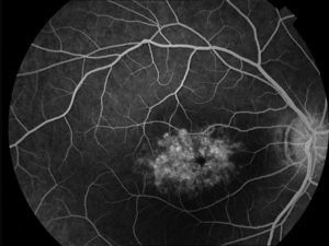 Angiografía fluoresceínica OD. Mácula con patrón en «ojo de buey».