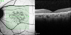 Izquierda: autofluorescencia OI. Derecha: tomografía óptica de coherencia OI. Engrosamiento hiperreflectivo a nivel de la capa de fotorreceptores.