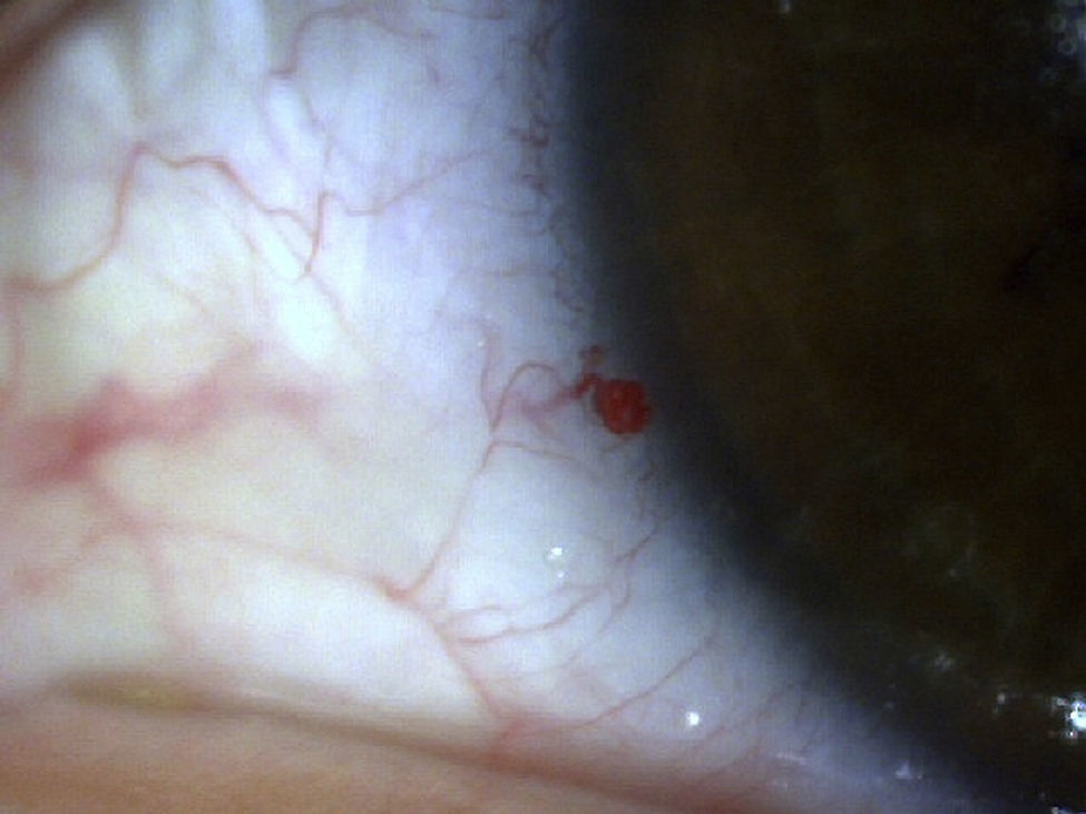 Microhemangioma Conjuntival Revista Mexicana De Oftalmolog a microhemangioma-conjuntival-revista-mexicana-de-oftalmolog-a