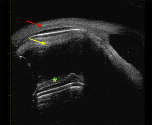 Ultrabiomicroscopia de un ojo con silicona en la cavidad vítrea. La flecha roja muestra la imagen real, en amarillo la imagen en espejo debajo del menisco de silicona, altamente reflectante. Eco de repetición dado por la superficie altamente reflectante del menisco de silicona (asterisco).