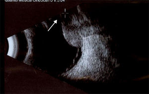 Proyección longitudinal con aparente ausencia de tejido posterior al cuerpo ciliar (flecha), como consecuencia de un artefacto por ángulo crítico.
