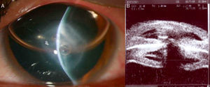 La imagen clínica (A) muestra el hídrops con gas en la cámara anterior y una burbuja en el estroma corneal. La imagen duplicada o en espejo se observa en la ultrabiomicroscopia (B), posterior a la línea de alta densidad que corresponde a la interfase endotelio-gas.