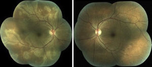 Fotografía clínica de ambos ojos, en ojo derecho se observa la presencia de lesiones placoides blanco-amarillentas que involucran polo posterior y se extienden fuera de las arcadas, papila de bordes sutilmente difusos. Ojo izquierdo de características normales.