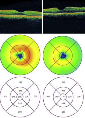 Tomografía de coherencia óptica ambos ojos; en el mapa macular, en el círculo concéntrico de los 3mm se aprecia un aumento del grosor retiniano en ojo derecho, ojo izquierdo de características normales.