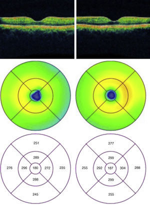 Tomografía de coherencia óptica un mes después de ambos ojos, en donde se aprecia una disminución en el volumen macular en el círculo de los 3mm en el ojo derecho.