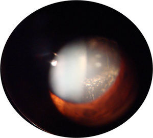 Fotografía de ojo derecho en la cual se aprecia hialosis asteroidea, vítreo organizado y turbidez vítrea 2+.