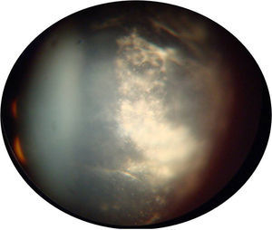 Fotografía de ojo izquierdo en la cual se aprecia vítreo organizado, turbidez 3+, no visible detalles en su totalidad.