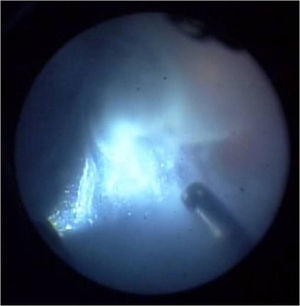 Vitrectomía vía pars plana de ojo izquierdo. Se observa vitreítis severa y aglomerados celulares.