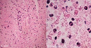 Fotomicrografías con tinción hematoxilina-eosina (A 40x, B 100x) que muestran un infiltrado difuso de células pequeñas de apariencia linfocítica con picnosis y cariorrexis (apoptosis celular) en un fondo necrótico.