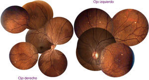 Reconstrucción de fondo de ojo del 26/dic/2013. A la izquierda: ojo derecho con cambios pigmentarios delimitados en sector nasal. A la derecha: ojo izquierdo de apariencia normal.