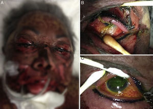 Dermatosis que afecta>30% ASC (A), daño ocular severo con presencia de seudomembranas en fórnix (B) y desepitelización corneal>80% (C).