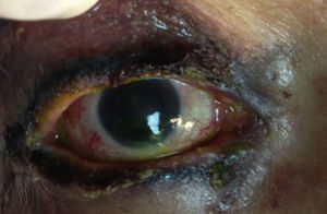 Aspecto ocular 4 días posteriores a la aplicación de membrana amniótica seca.
