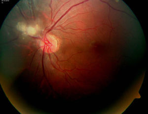 Hamartoma astrocítico nodular calcificado en ojo izquierdo.