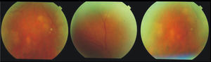 En funduscopia del ojo derecho se observan múltiples tubérculos coroideos, zonas de vasculitis periférica, algunas activas y otras cicatrizando; la funduscopia del ojo izquierdo era normal.