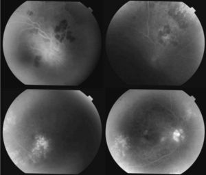 También un mes después del diagnóstico en las angiografías fluoresceínicas se ven zonas de hipofluorescencia inicial, que luego evolucionan a hiperfluorescencia, lo que indica todavía cierta actividad de los focos coroideos, junto con zonas de atrofia que implican resolución del proceso.