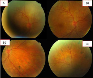 A. A los 40 días el proceso coroideo evoluciona positivamente; apenas hay vitreítis ni focos coroideos activos. Se aplicó láser en retina del ojo derecho por desgarros producidos por el proceso inflamatorio. B1, B2 y B3. Fotos a los 80 días: proceso en estado cicatricial.
