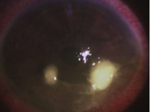 Fotografía clínica de úlcera corneal bacteriana.