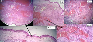 Vista microscópica. (A) Corte histológico de la lesión. (A-1) La lesión está bien delimitada por tejido epitelial dermis y epidermis. (B) Se observa en el estroma una neoplasia de origen vascular, donde se aprecian espacios vasculares. (B-1) Rotura de la pared del vaso; en el interior de la luz se observa formación de fibrina y acúmulo de eritrocitos. Diagnóstico por patología: hemangioma capilar.