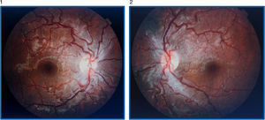 Fondo de ojo donde se observa hiperemia papilar, tortuosidad vascular y telangiectasias peripapilares en ambos ojos.