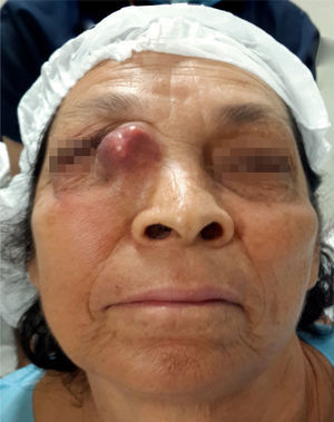 Paciente femenina de 64 años que acude a consulta oftalmológica por presentar una tumoración en canto interno del ojo derecho de 3 años de evolución asociada a secreción hemática, epifora y diplopía horizontal.