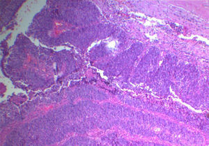 Sección histolo¿gica teñida con hematoxilina y eosina con aumento 100x. Revela neoplasia de estirpe epitelial compuesta por láminas de contorno redondeado y distribución en empalizada en la periferia.