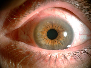 Infiltrado corneal superior con adelgazamiento y vasculitis limbar.