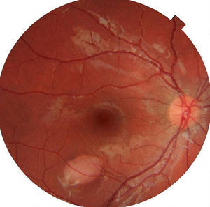 Fundus photograph of the right eye. Torpedo-shape lesion located temporal to the macula.