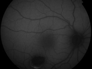 Fundus autofluorescence showing severe loss of autofluorescence signal throughout the lesion except at the lower edge, where it is clearly hyperautoflorescent.