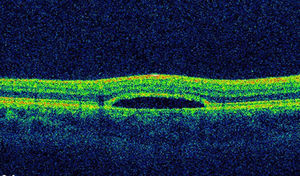 Optical coherence tomograph showing sensory retinal detachment.