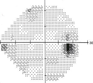 Humphrey visual field (24-2) test result, showing a corresponding scotoma.