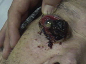 Clinical picture of the tumoral lesion before surgical removal.