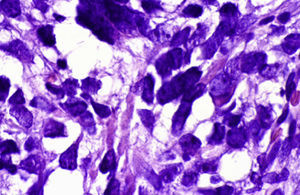 Histopathology picture of the lesion.