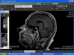 Resonancia magnética de cráneo: imagen sugerente de isquemia a nivel pontino bajo.