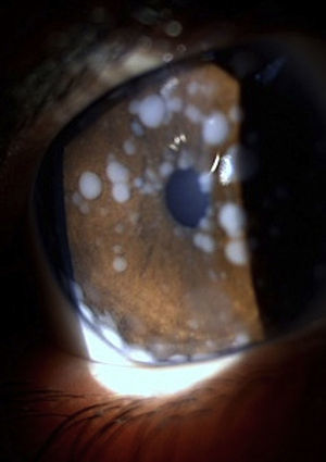 Se aprecia la presencia de siembras de retinoblastoma en borde pupilar, resto del iris y en sector inferior del ángulo iridocorneal del OD.