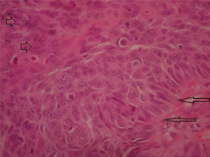 Imagen histológica de células basaloides perivasculares asociadas a nidos de células con diferenciación escamosa y actividad mitótica. Flechas largas: células empalizadas basaloides. Flechas cortas: células con diferenciación escamosa.