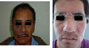 Image corresponding to rehabilitated patients with a prosthesis orbitofacial.