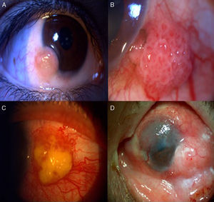 (A) Carcinoma epidermoide gelatinoso de ojo derecho. (B) Carcinoma epidermoide papilomatoso. (C) Carcinoma epidermoide leucopláquico. (D) Carcinoma epidermoide difuso.