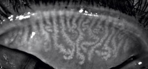 Análisis de meibografía infrarroja con el equipo Keratograph® en un paciente con tortuosidad de las glándulas de Meibomio.