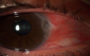 Biomicroscopía anterior de la córnea, ojo derecho. Lesión corneal periférica, con bordes grises, inyección cilioconjuntival y edema conjuntival.