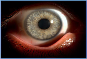 Alteraciones de la coloración de iris con hipocromía y atrofia periférica.