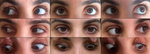 After corticosteroid treatment, gaze palsy resolved within three weeks.