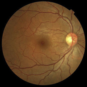 Fotografía convencional de un fondo de ojo normal, que abarca 45 grados. En la imagen se puede apreciar poco más allá de las arcadas vasculares.